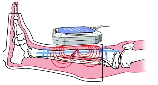 Magnetoterapija